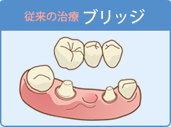 従来の治療ブリッジ