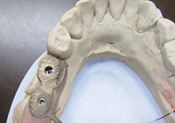 STEP5 仮歯、仮義歯の作成、診療用模型のかたどり