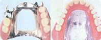 金属床コバルルトクロム床義歯